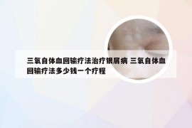 三氧自体血回输疗法治疗银屑病 三氧自体血回输疗法多少钱一个疗程