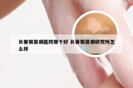 长春银屑病医院那个好 长春银屑病研究所怎么样