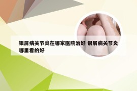 银屑病关节炎在哪家医院治好 银屑病关节炎哪里看的好