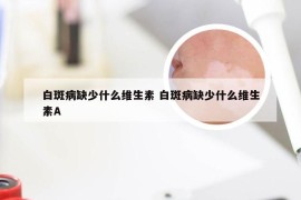 白斑病缺少什么维生素 白斑病缺少什么维生素A