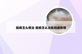 腿癣怎么根治 腿癣怎么治能彻底除根