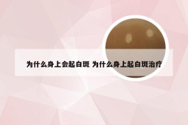 为什么身上会起白斑 为什么身上起白斑治疗