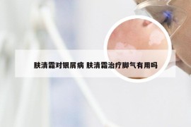 肤清霜对银屑病 肤清霜治疗脚气有用吗