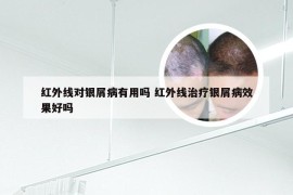 红外线对银屑病有用吗 红外线治疗银屑病效果好吗