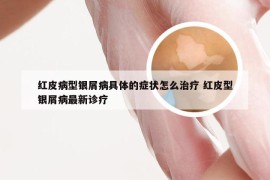 红皮病型银屑病具体的症状怎么治疗 红皮型银屑病最新诊疗