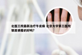 北医三院最新治疗牛皮癣 北京大学第三医院银屑病看的好吗?