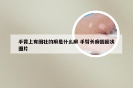 手臂上有圈壮的癣是什么癣 手臂长癣圆圈状图片