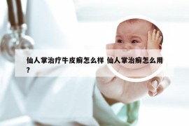 仙人掌治疗牛皮癣怎么样 仙人掌治癣怎么用?