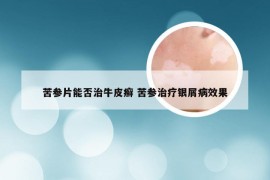 苦参片能否治牛皮癣 苦参治疗银屑病效果