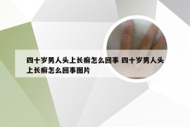 四十岁男人头上长癣怎么回事 四十岁男人头上长癣怎么回事图片