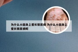 为什么小腿身上爱长银屑病 为什么小腿身上爱长银屑病呢