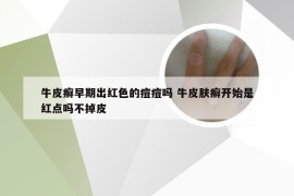 牛皮癣早期出红色的痘痘吗 牛皮肤癣开始是红点吗不掉皮