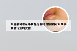 银屑病可以从事食品行业吗 银屑病可以从事食品行业吗女性