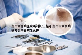 郑州银屑病医院听刘长江当问 郑州市银屑病研究会所看病怎么样