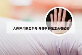 人身体长癣怎么办 身体长藓是怎么引起的