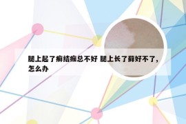 腿上起了癣结痂总不好 腿上长了藓好不了,怎么办