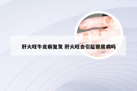 肝火旺牛皮癣复发 肝火旺会引起银屑病吗