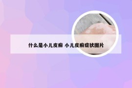 什么是小儿皮癣 小儿皮癣症状图片