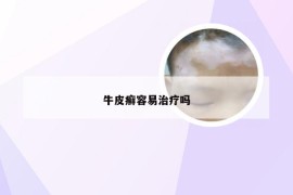 牛皮癣容易治疗吗