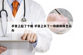 手背上起了个癣 手背上长了一块癣痒痒怎么办