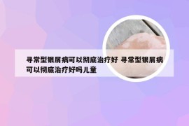 寻常型银屑病可以彻底治疗好 寻常型银屑病可以彻底治疗好吗儿童