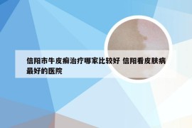 信阳市牛皮癣治疗哪家比较好 信阳看皮肤病最好的医院