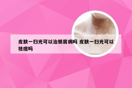 皮肤一扫光可以治银屑病吗 皮肤一扫光可以祛痘吗