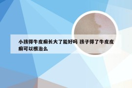 小孩得牛皮癣长大了能好吗 孩子得了牛皮皮癣可以根治么