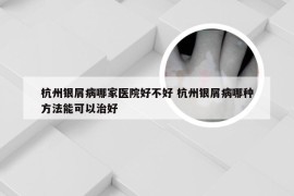 杭州银屑病哪家医院好不好 杭州银屑病哪种方法能可以治好