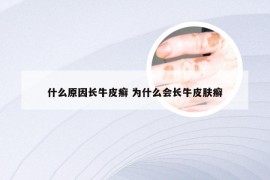 什么原因长牛皮癣 为什么会长牛皮肤癣