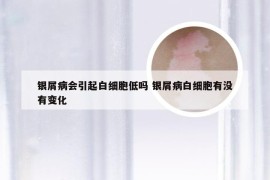 银屑病会引起白细胞低吗 银屑病白细胞有没有变化