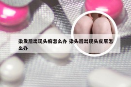 染发后出现头癣怎么办 染头后出现头皮屑怎么办