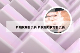 白癫疯用什么药 白疯癫症状擦什么药