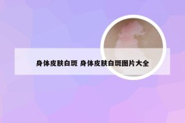 身体皮肤白斑 身体皮肤白斑图片大全