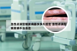 急性点滴型银屑病最快多久痊愈 急性点滴型银屑病不治自愈