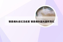 银屑病头皮红没皮屑 银屑病头部大面积发红