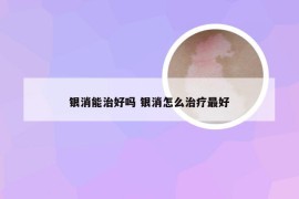 银消能治好吗 银消怎么治疗最好