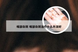 嘴部白斑 嘴部白斑治疗什么方法好