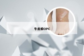 牛皮癣OPC