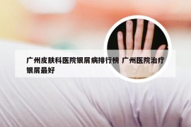 广州皮肤科医院银屑病排行榜 广州医院治疗银屑最好