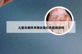 儿童白癜风早期会是红色疤痕状吗