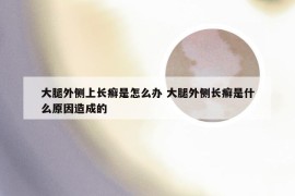 大腿外侧上长癣是怎么办 大腿外侧长癣是什么原因造成的