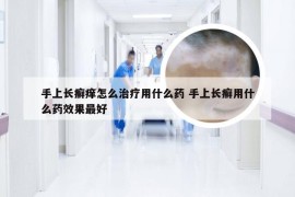 手上长癣痒怎么治疗用什么药 手上长癣用什么药效果最好