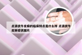 点滴状牛皮癣的临床特点是什么样 点滴状牛皮鲜症状图片