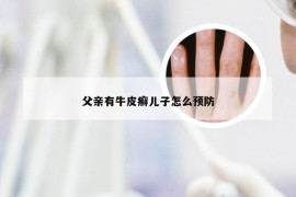 父亲有牛皮癣儿子怎么预防