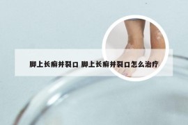 脚上长癣并裂口 脚上长癣并裂口怎么治疗