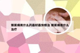 银屑病用什么药最好最快根治 银屑病用什么治疗