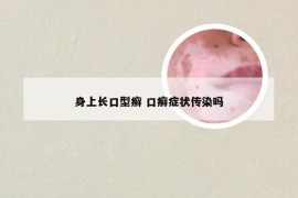 身上长口型癣 口癣症状传染吗