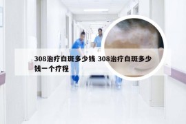 308治疗白斑多少钱 308治疗白斑多少钱一个疗程