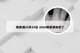 银屑病10月29日 2020银屑病有救了